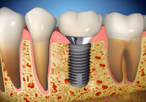 Implantes Dentários.