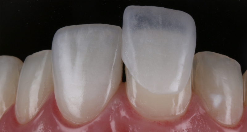 Lentes de Contato Dental e Fragmentos Cerâmicos