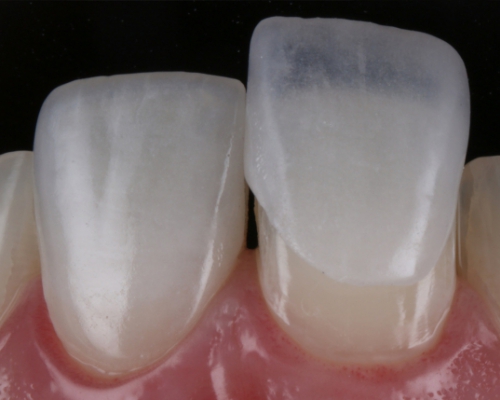 Lentes de Contato Dental e Fragmentos Cerâmicos